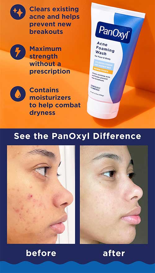 PanOxyl Acne Foaming WashPanOxyl Acne Foaming Wash Benzoyl Peroxide 10% Maximum Strength Antimicrobial, 5.5 Oz is one of the top Facial Cleansers